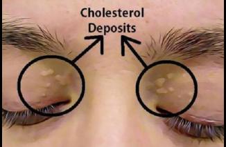 Kolesterol Tinggi Bisa Diketahui dengan Dua Petunjuk Ini
