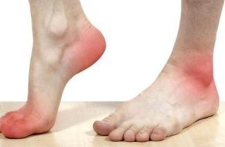 Kolesterol Anda Tinggi? Coba Cek di Kaki