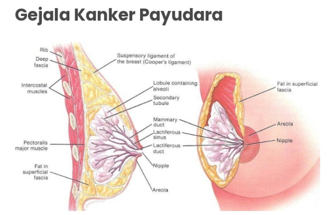 Kaum Hawa Perlu Waspada, Berikut Tanda Kanker Payudara Meneror