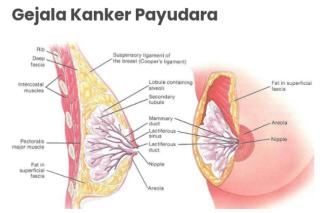 Kaum Hawa Perlu Waspada, Berikut Tanda Kanker Payudara Meneror