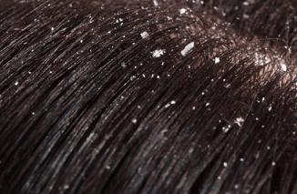 Foto 4 Kebiasaan Sepele yang Memicu Ketombe Berkelan