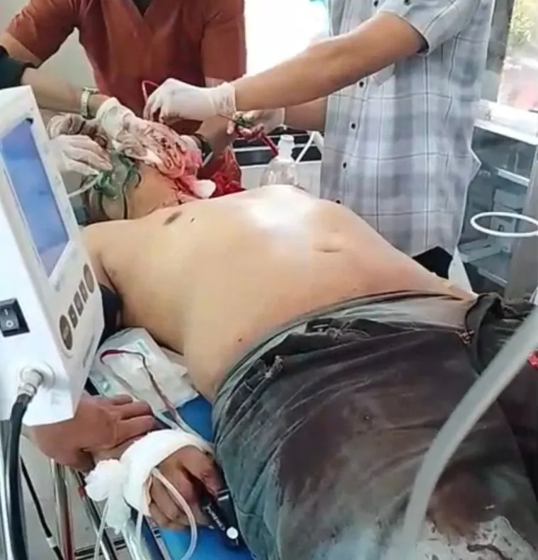Bentrok Sesama Anggota Polisi di Pohuwato, BRIPKA Indra Jadi Korban Penganiayaan Parang